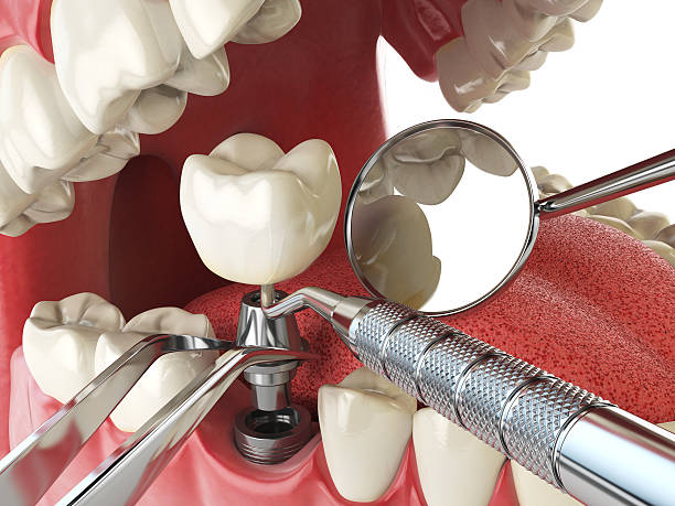 Best Emergency Tooth Extraction in Chickasha, OK
